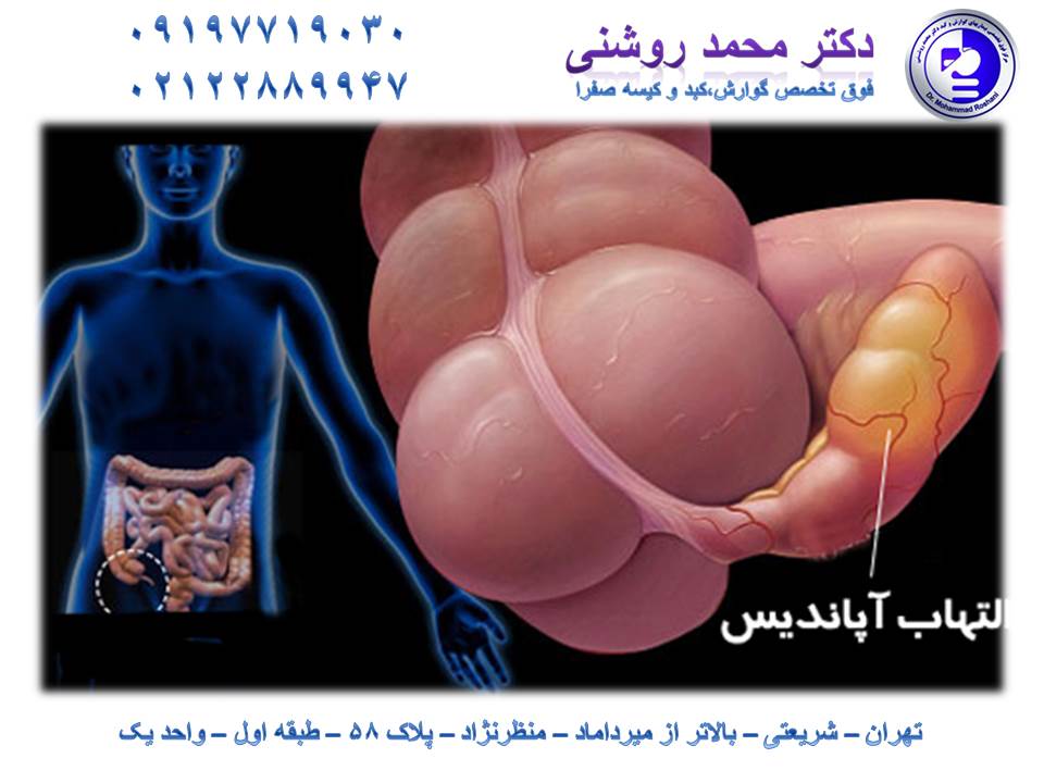 محمد روشنی 1 - آپاندیسیت چیست؟