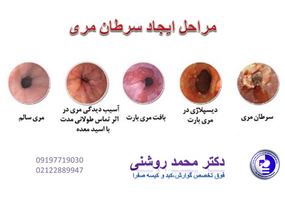رابطه ریفلاکس و مری بارت محمد روشنی 3 - رابطه ریفلاکس و مری بارت