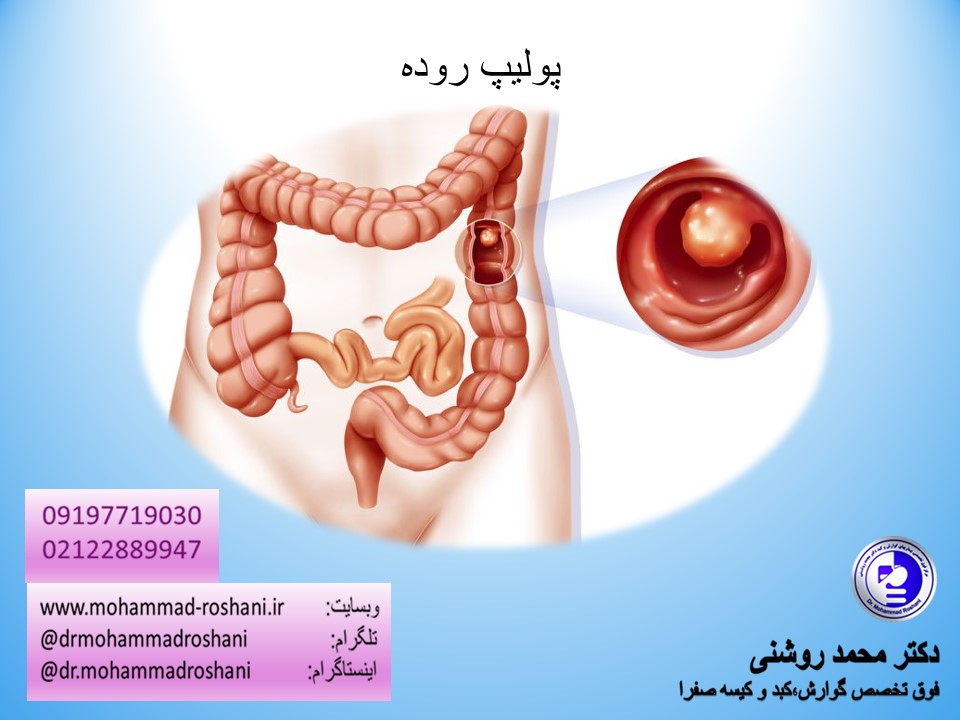 روده - ناراحتی گوارشی یا سرطان روده ؟
